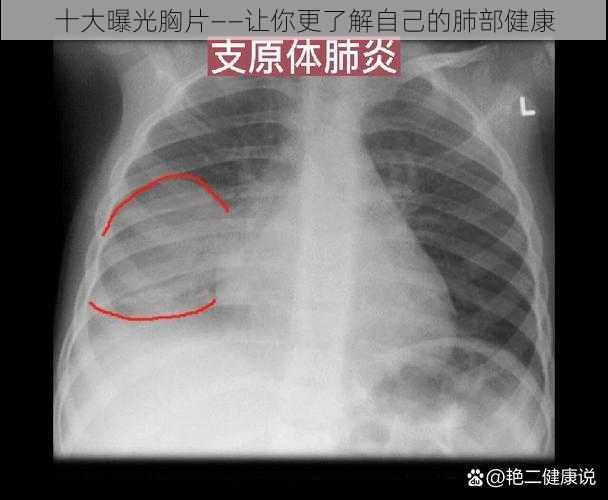 十大曝光胸片——让你更了解自己的肺部健康