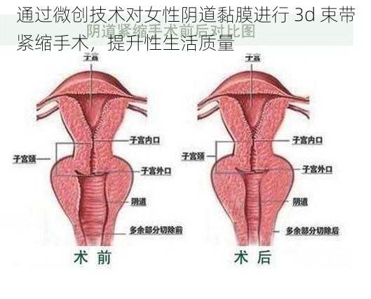 通过微创技术对女性阴道黏膜进行 3d 束带紧缩手术，提升性生活质量